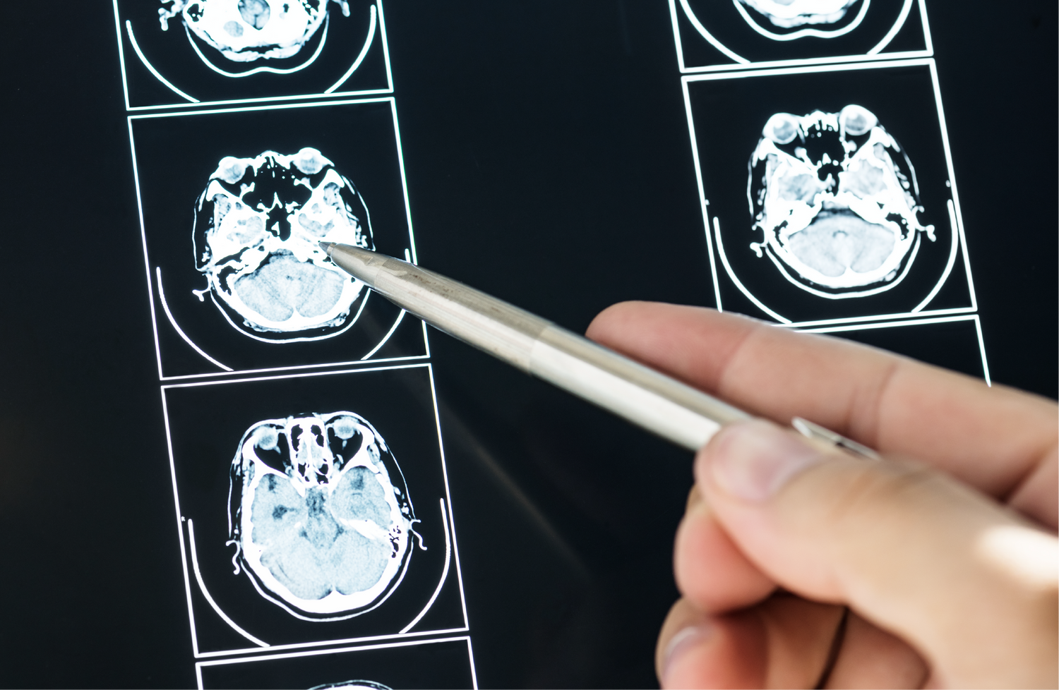 Creatina y cerebro: el suplemento que empezó en el músculo y hoy apunta a la salud cognitiva